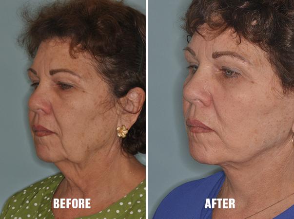 Necklift Before and After Photos in Miami, FL, Patient 2546