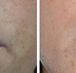 Non Surgical Before and After Photos in Miami, FL, Patient 2669