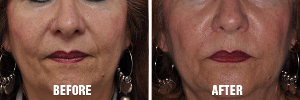 Non Surgical Before and After Photos in Miami, FL, Patient 2647