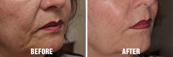 Non Surgical Before and After Photos in Miami, FL, Patient 2647