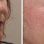 Non Surgical Before and After Photos in Miami, FL, Patient 2647