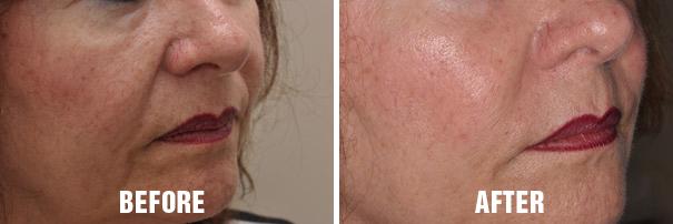 Non Surgical Before and After Photos in Miami, FL, Patient 2647