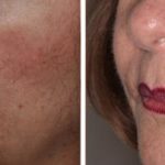 Non Surgical Before and After Photos in Miami, FL, Patient 2647