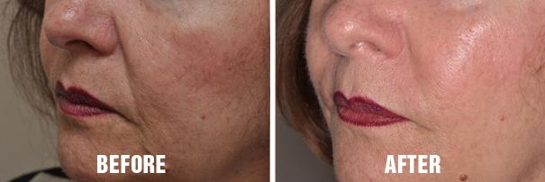 Non Surgical Before and After Photos in Miami, FL, Patient 2647