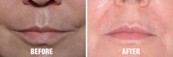 Non Surgical Before and After Photos in Miami, FL, Patient 2652