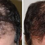 Hair Restoration Before and After Photos in Miami, FL, Patient 1619