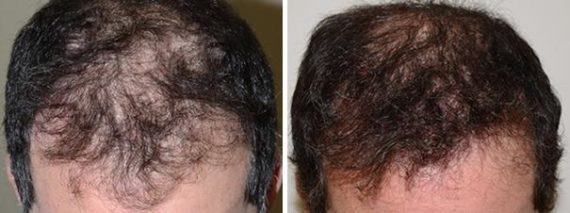 Hair Restoration Before and After Photos in Miami, FL, Patient 1619