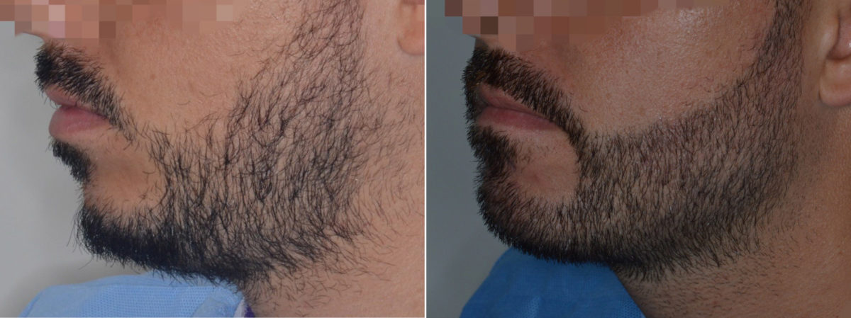 Hair Restoration Before and After Photos in Miami, FL, Patient 3086