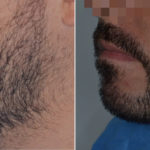 Hair Restoration Before and After Photos in Miami, FL, Patient 3086