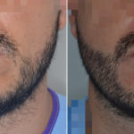 Hair Restoration Before and After Photos in Miami, FL, Patient 3086