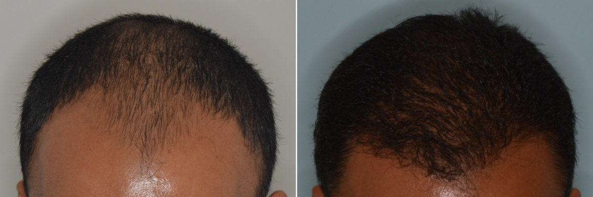 Hair Transplant Before and After Photos in Miami, FL, Patient 3112