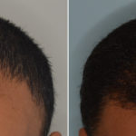 Hair Transplant Before and After Photos in Miami, FL, Patient 3112