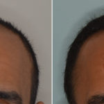 Hair Transplant Before and After Photos in Miami, FL, Patient 3112