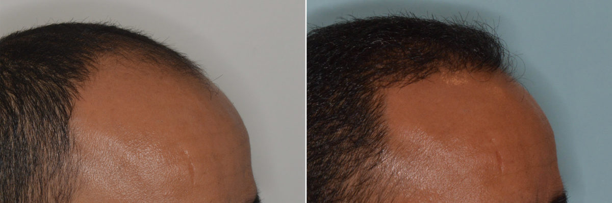 Hair Transplant Before and After Photos in Miami, FL, Patient 3112