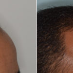 Hair Transplant Before and After Photos in Miami, FL, Patient 3112