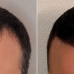 Hair Transplant Before and After Photos in Miami, FL, Patient 3246