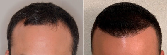 Hair Transplant Before and After Photos in Miami, FL, Patient 3246