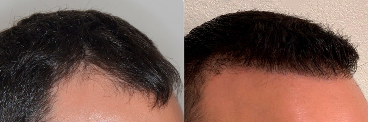 Hair Transplant Before and After Photos in Miami, FL, Patient 3246