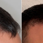 Hair Transplant Before and After Photos in Miami, FL, Patient 3246