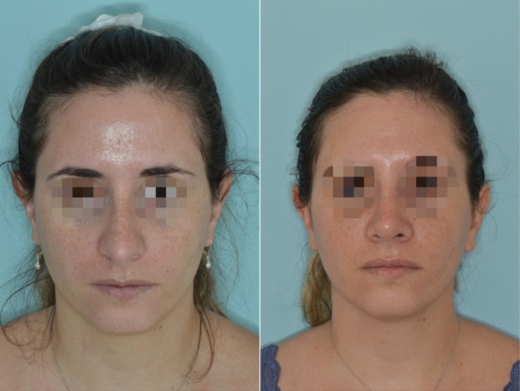 Rhinoplasty Before and After Photos in Miami, FL, Patient 3258