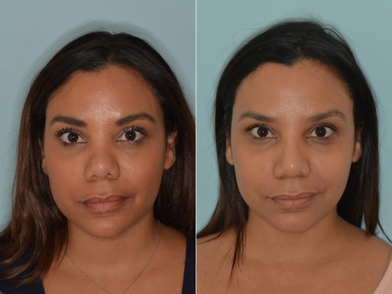 Rhinoplasty Before and After Photos in Miami, FL, Patient 3235