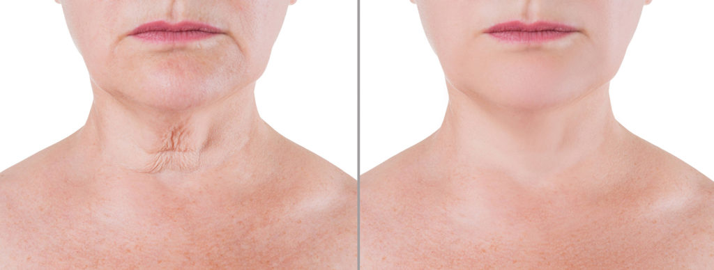 People who have drastic weight loss are good candidates for Neck lifts