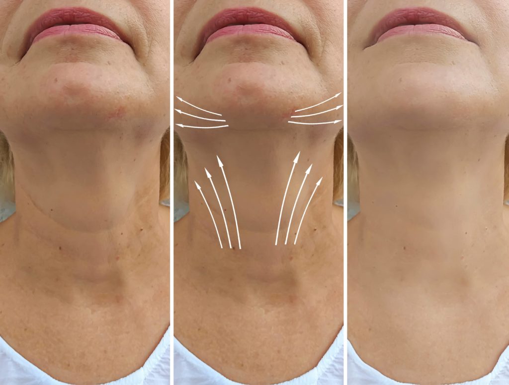 During a neck lift the overall neck muscles can also be tightened