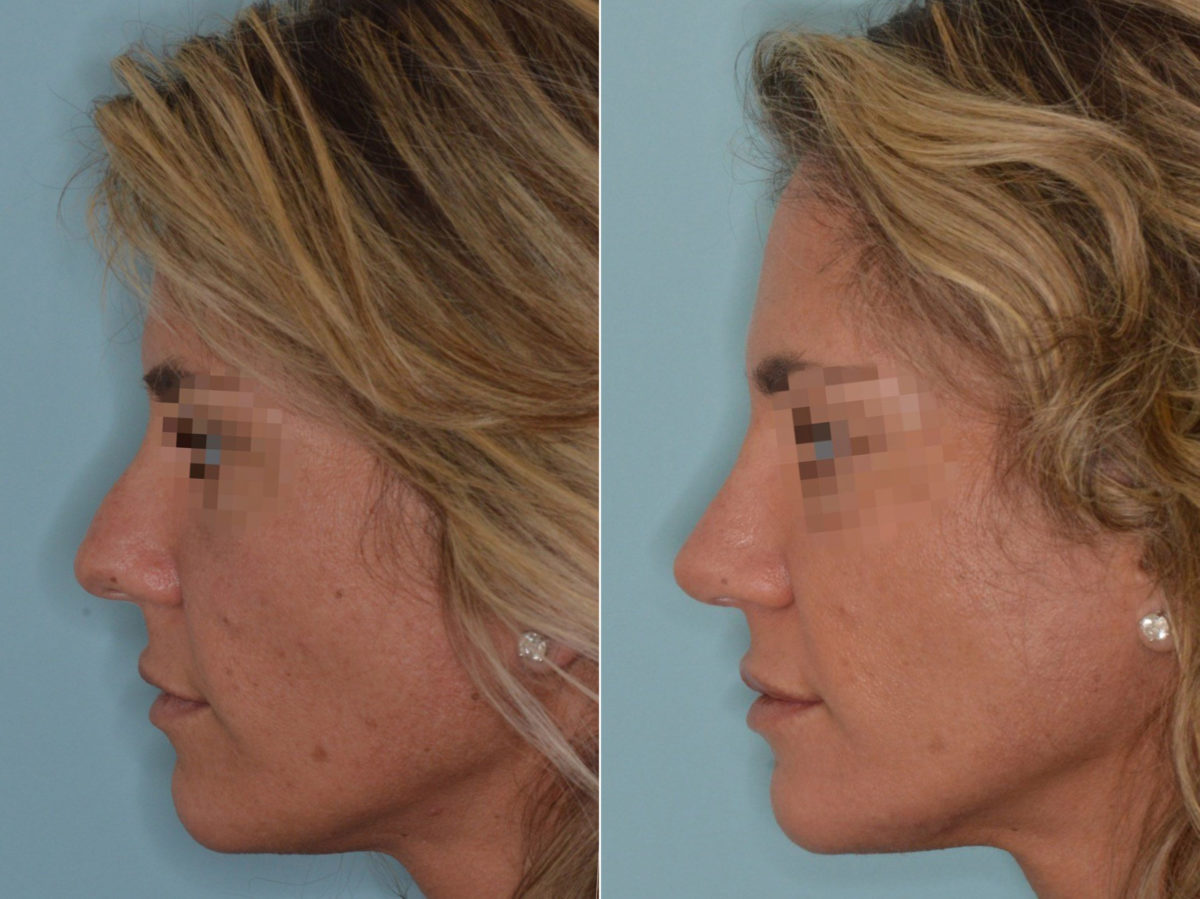 Rhinoplasty Before and After Photos in Miami, FL, Patient 3333