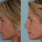 Rhinoplasty Before and After Photos in Miami, FL, Patient 3333