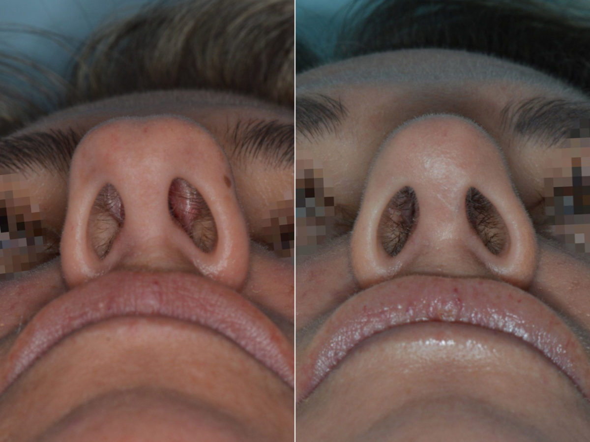 Rhinoplasty Before and After Photos in Miami, FL, Patient 3333