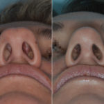 Rhinoplasty Before and After Photos in Miami, FL, Patient 3333