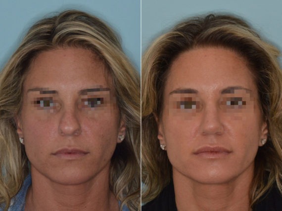 Rhinoplasty Before and After Photos in Miami, FL, Patient 3333