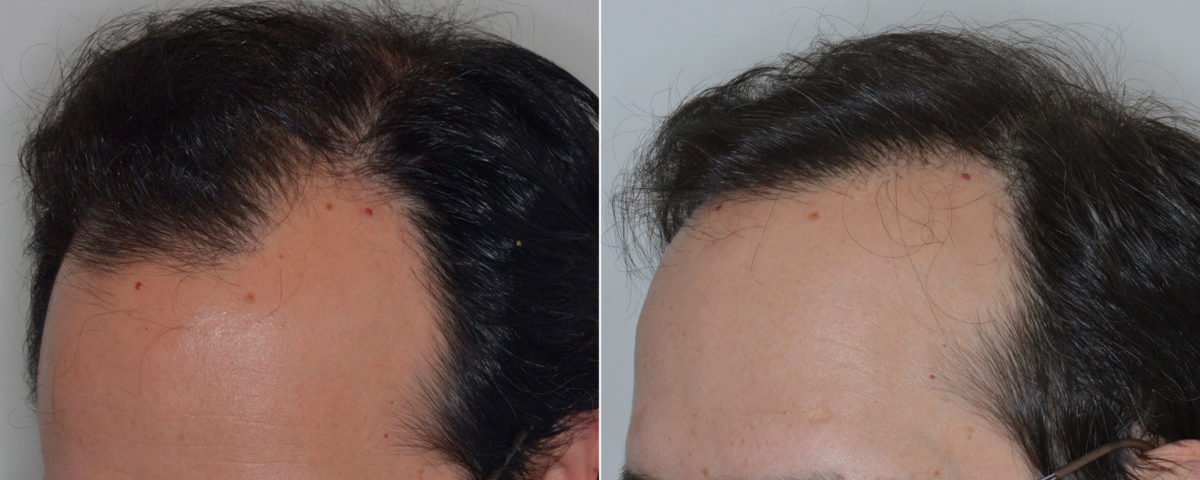 Hair Transplant Before and After Photos in Miami, FL, Patient 3394