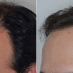 Hair Transplant Before and After Photos in Miami, FL, Patient 3394