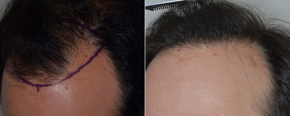 Hair Transplant Before and After Photos in Miami, FL, Patient 3394