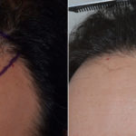 Hair Transplant Before and After Photos in Miami, FL, Patient 3394