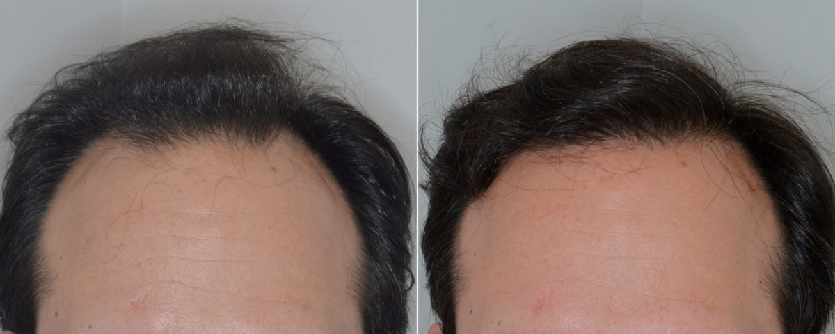 Hair Transplant Before and After Photos in Miami, FL, Patient 3394