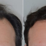 Hair Transplant Before and After Photos in Miami, FL, Patient 3394