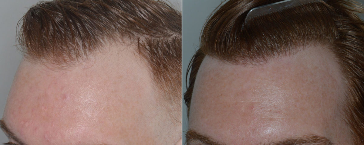 Hair Transplant Before and After Photos in Miami, FL, Patient 3468