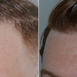 Hair Transplant Before and After Photos in Miami, FL, Patient 3468