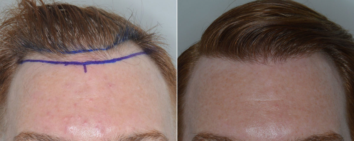 Hair Transplant Before and After Photos in Miami, FL, Patient 3468