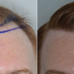 Hair Transplant Before and After Photos in Miami, FL, Patient 3468