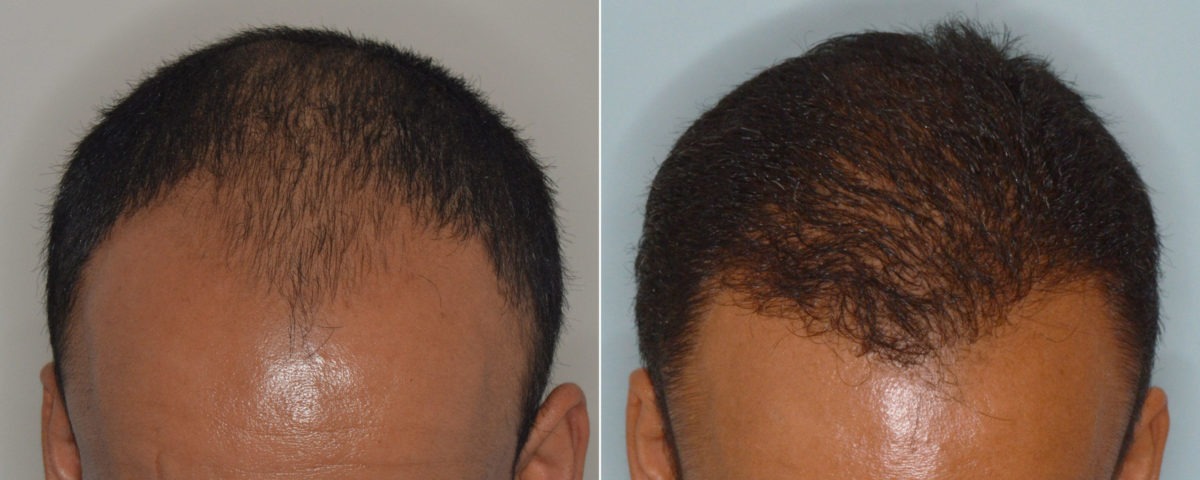 Hair Transplant Before and After Photos in Miami, FL, Patient 3486