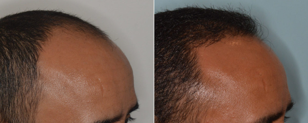 Hair Transplant Before and After Photos in Miami, FL, Patient 3486