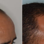 Hair Transplant Before and After Photos in Miami, FL, Patient 3486