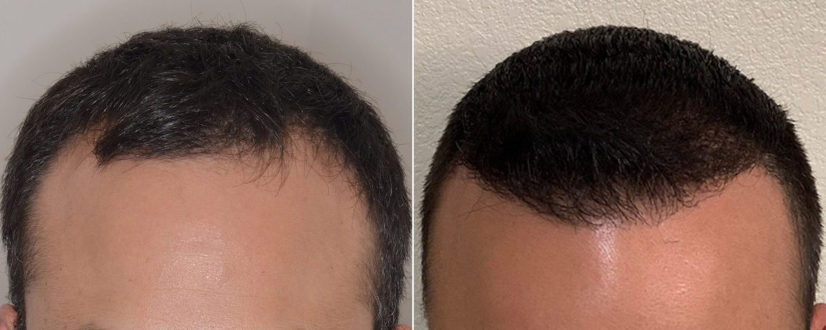 Hair Transplant Before and After Photos in Miami, FL, Patient 3496