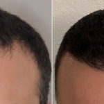 Hair Transplant Before and After Photos in Miami, FL, Patient 3496