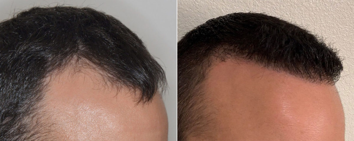 Hair Transplant Before and After Photos in Miami, FL, Patient 3496