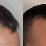 Hair Transplant Before and After Photos in Miami, FL, Patient 3496