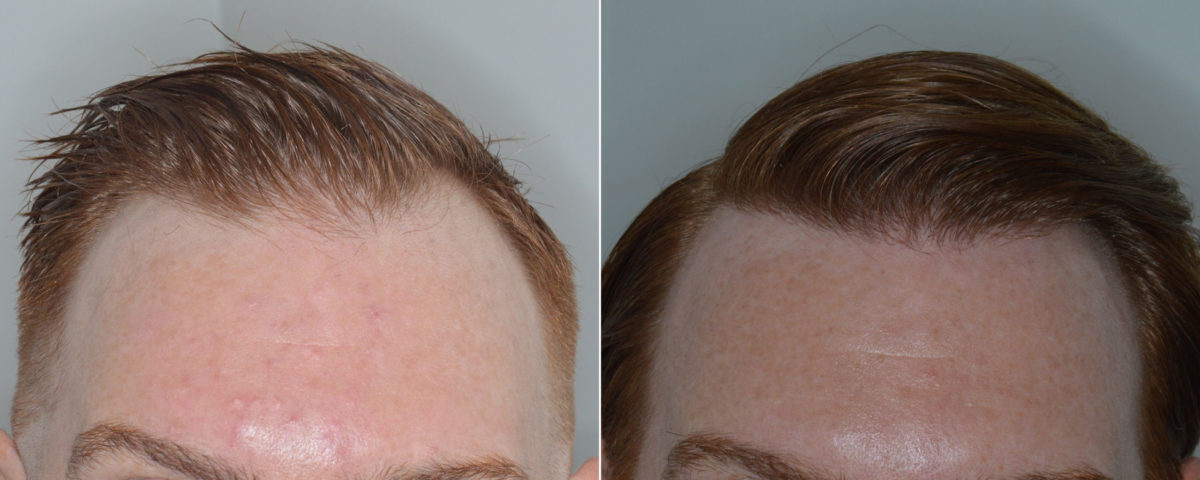 Hair Transplant Before and After Photos in Miami, FL, Patient 3468